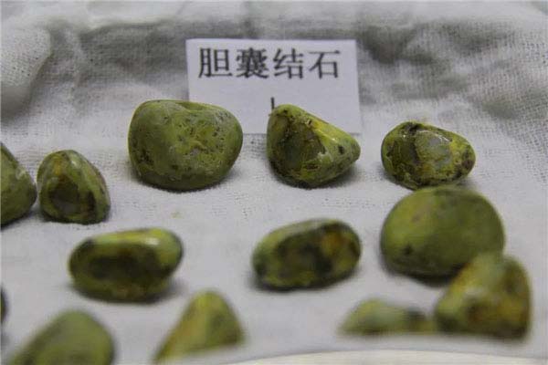 世界上最大的人体胆结石，重达12.58千克