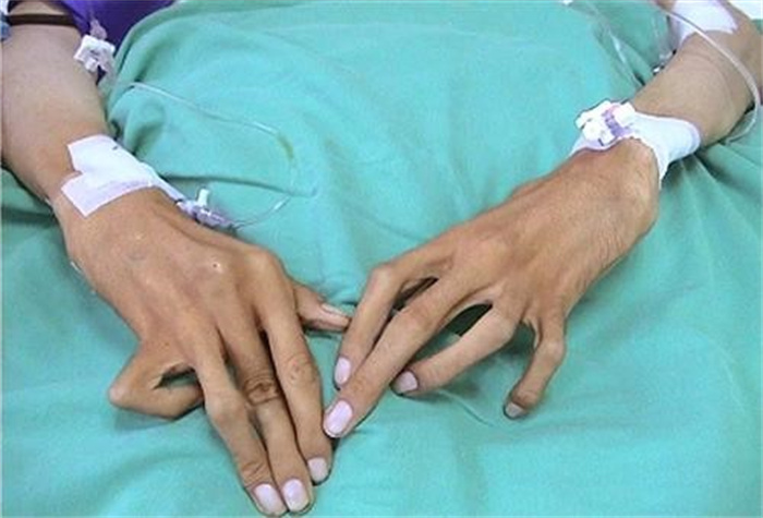一家族7人确诊马凡氏综合征 又叫天才病