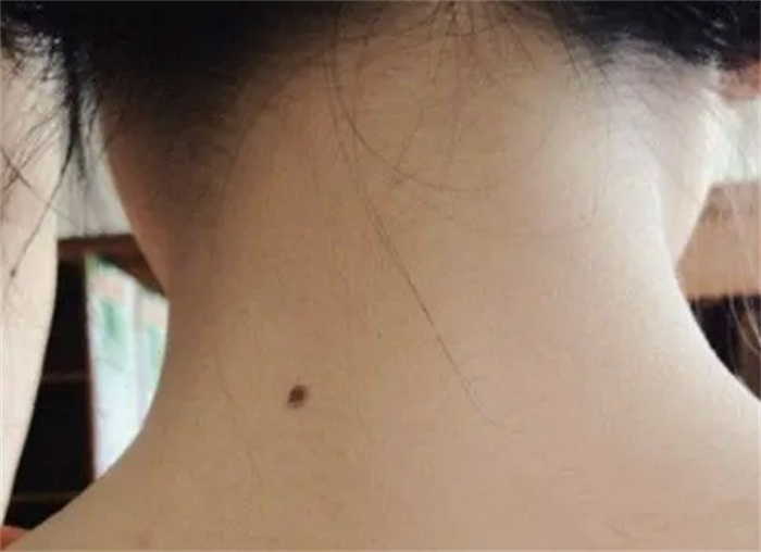 后背长痣看运势，不同位置运势大不同，你的身上有没有？