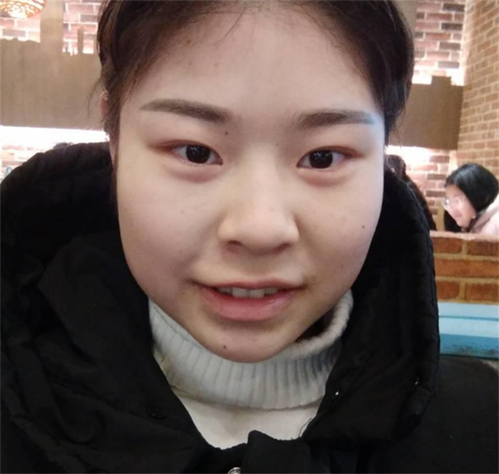 脸上这三个位置有痣 就说明会有好运（脸上有痣，鼻子，额头）