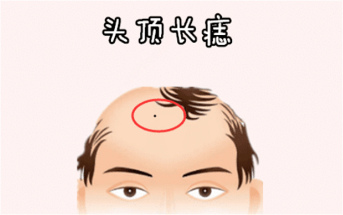 男人头顶有痣有什么说法 什么是富贵痣（下巴有痣）