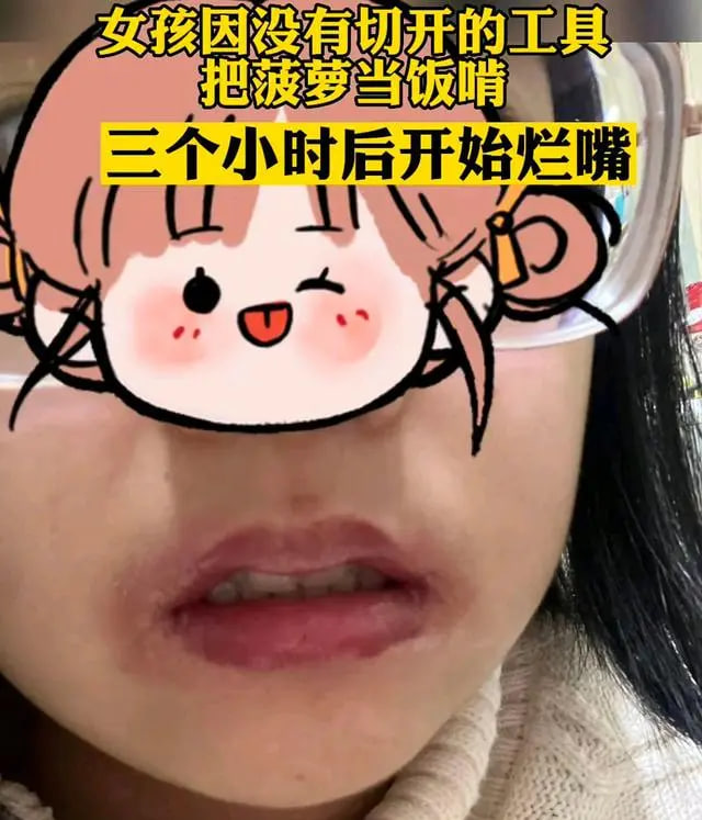女孩菠萝当午饭 吃完后嘴巴烂掉（菠萝烂嘴）