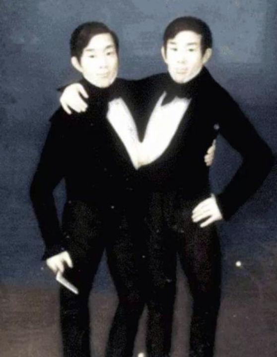 史上最著名的连体双胞胎：一直活到62岁逝去（同卵双胞胎）