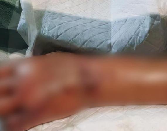 某地老人洗虾指被刺，截肢保命，为海鲜所系（被海鲜刺及时就医）