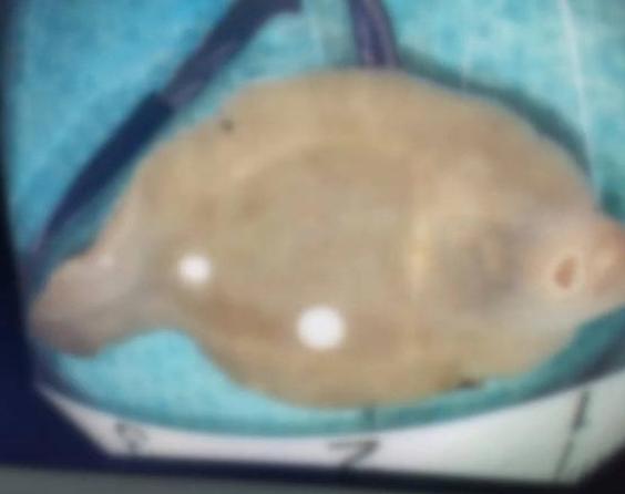 一女子的肝脏竟然被虫子当成食物，虫子取出仍具攻击性