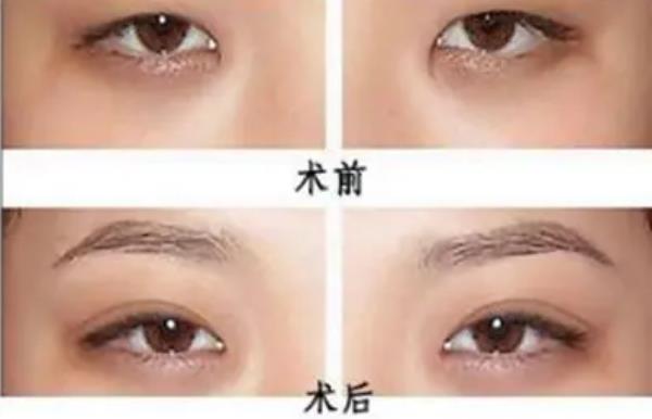 割双眼皮手术要多少钱：5000-20000元，术后不要熬夜
