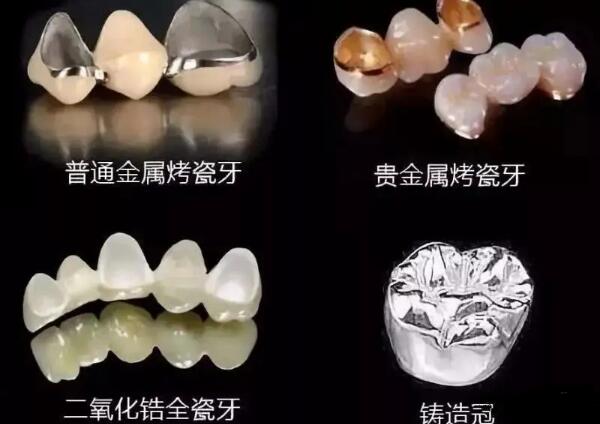 换一颗牙多少钱：1000-6000元之间，金属烤瓷牙最贵