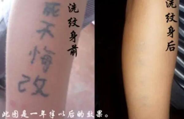洗纹身多少钱：2000-10000元左右，通常需洗4-6次