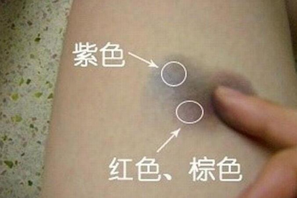 为什么皮肤碰伤后会青紫?皮下出血氧气流失(血液变暗)