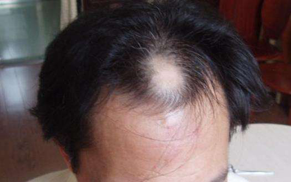 年轻人脱发怎么办?脱发应该如何治疗(食疗、药物治疗)